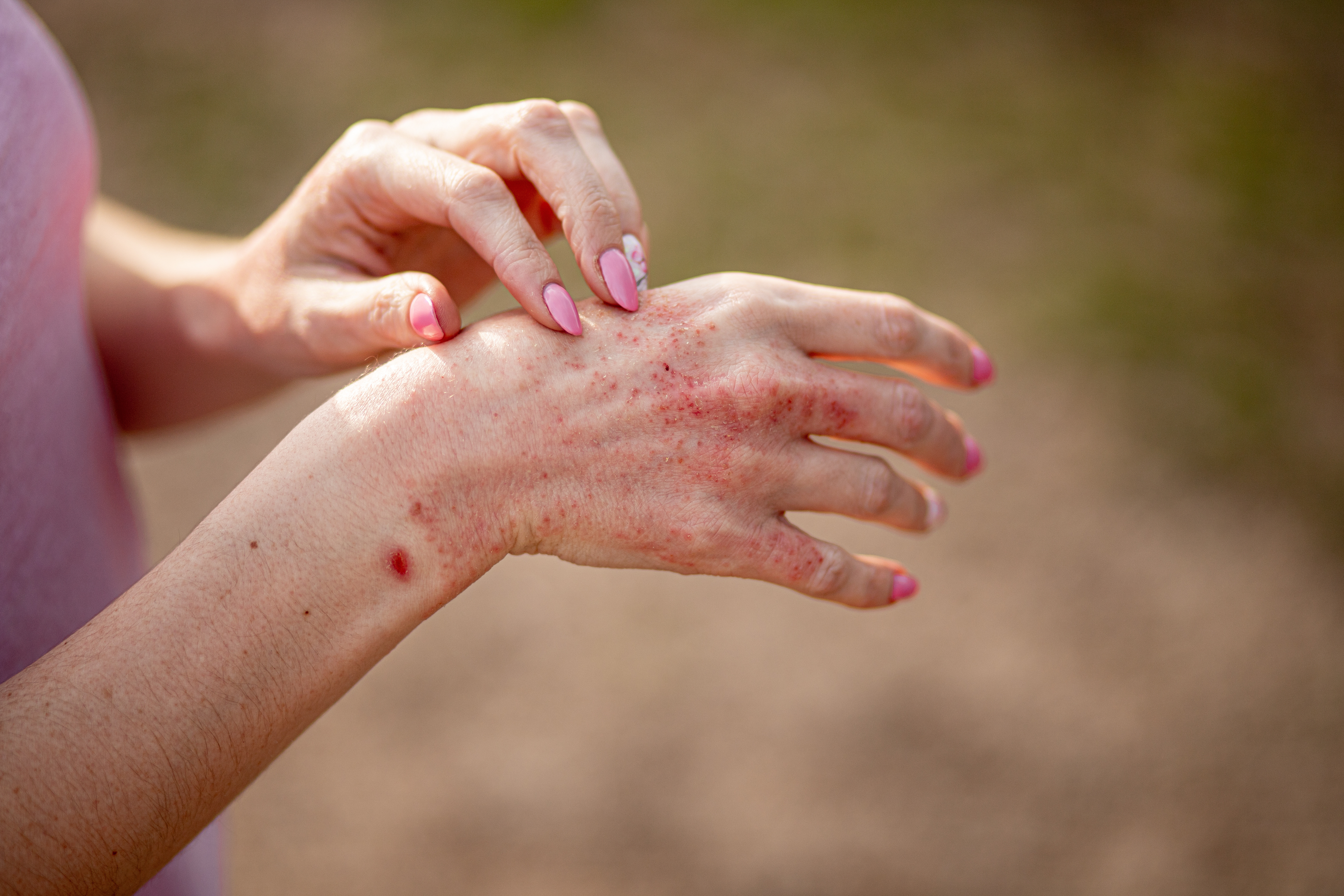 Chronic Hand Eczema White {a[er